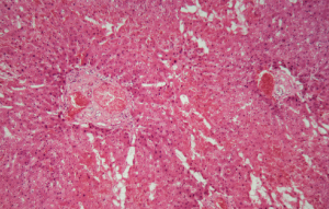 Liver tissue with amyloidosis