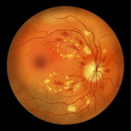 Illustration of a retina showing signs of retinopathy, including yellow exudates, haemorrhages and pale cotton wool spots around the optic disc.